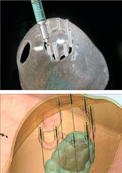 韓開發3D印表機手術法 提高乳腺癌手術精確度(圖)